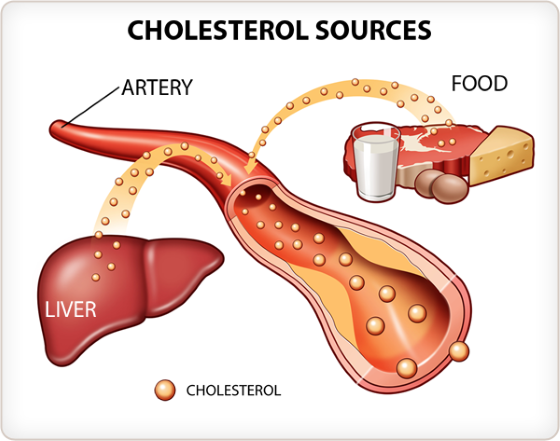 Vysoká hladina cholesterolu v těle, může být jednou z předních příčin vzniku aterosklerózy